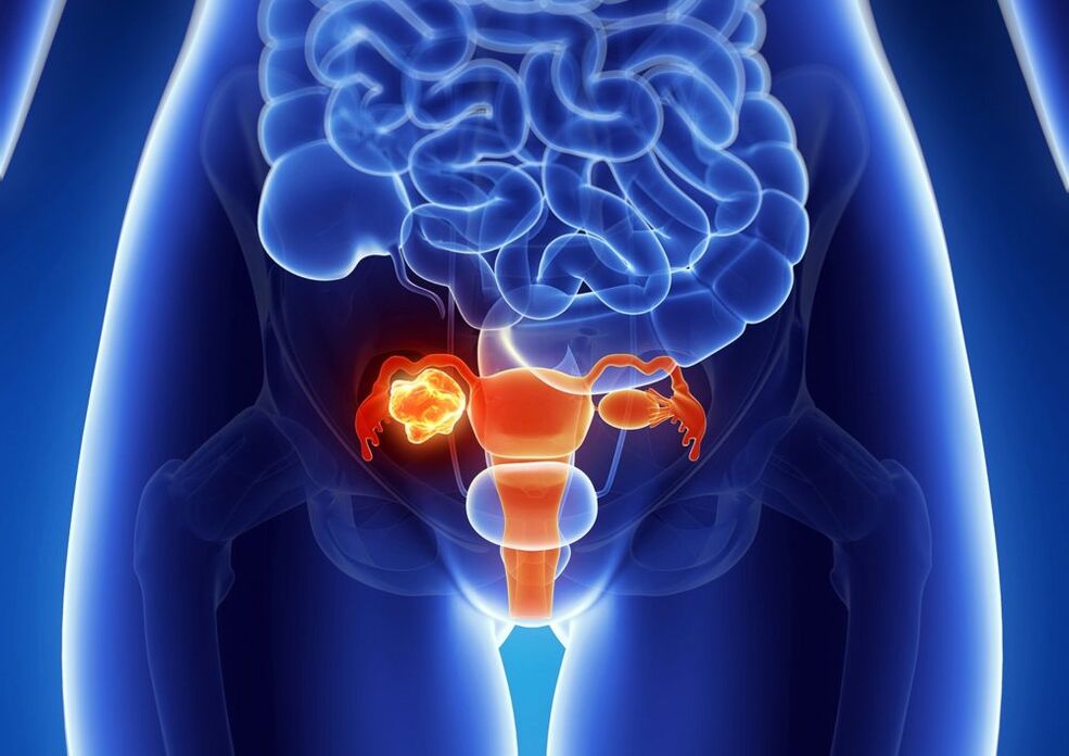 The pathology of the woman's ovaries under the influence of alcohol